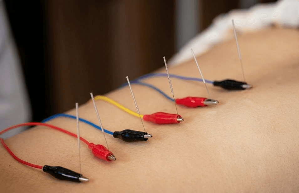 전침 치료